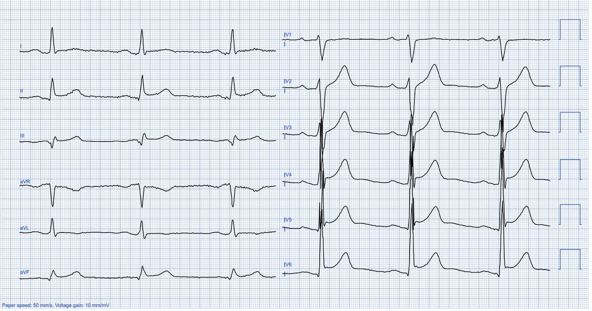 32 year old man, chest pain since 2 days after diarrhea. What is the most likely diagnosis? 50 mm/s!!! 
<a href="/Jigarbuddhdev4/">Dr jigar</a> <a href="/Ecgloverr/">Pedram</a> <a href="/Jagdish26039718/">Jagdish Singh</a> @PacingSpike <a href="/mohammadala33/">Mohammad Elidy</a> <a href="/JustusLimo/">Justus K Limo Mbugua🇰🇪</a> <a href="/hscott61/">hscott61</a> <a href="/TSM_Humanist/">Tariq Mir</a> <a href="/MusaMayayise/">Dr Musa Mayayise</a> <a href="/Zamandaulatkhel/">Afreedi Zaman</a> <a href="/Basalus/">Mounir Basalus (Ⲃⲁⲥⲓⲗⲓⲟⲥ)</a>