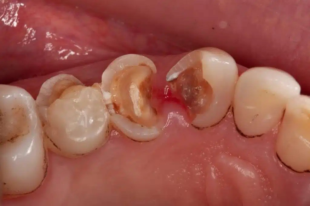 Dentagama's tweet photo. Tooth restoration with PFM crowns https://t.co/u2MHNb8VRs