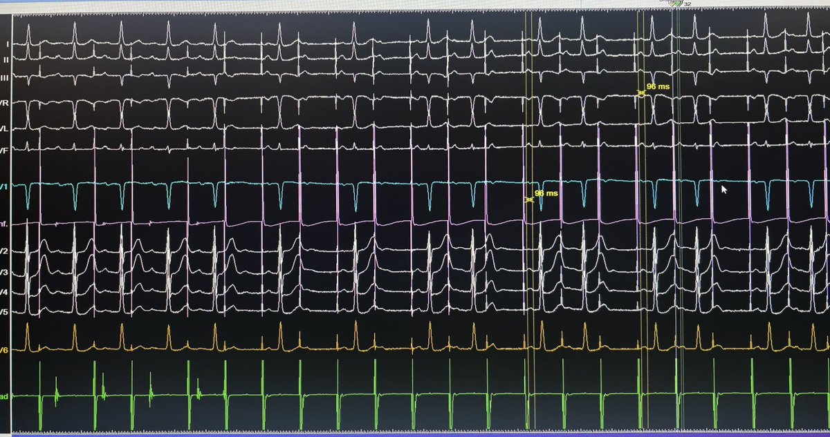 Kevin Vernooy (@kvernooy) on Twitter photo Bachmann bundle pacing + LBBP in pt with HFPEF and AVB2
Field of cardiac paving is getting more and more interesting
<a href="/JLuermans/">Justin Luermans</a> <a href="/BobWeijs/">Bob Weijs</a> <a href="/lusty63/">Dan Lustgarten MDPhD</a> <a href="/Dr_JozaEP/">Jacqueline Joza</a> <a href="/Phiso_de/">Philipp Sommer</a> <a href="/purerfellner/">Dr. Helmut Pürerfellner</a> <a href="/ZanonFrancesco/">Francesco Zanon</a> <a href="/OCanoPerez/">Óscar Cano</a> <a href="/V_Mardigyan/">Vartan Mardigyan</a> <a href="/KennethEllenbo1/">Kenneth Ellenbogen</a> <a href="/IsraelCarsten/">Carsten W.Israel</a> Bachmann bundle pacing + LBBP in pt with HFPEF and AVB2
Field of cardiac paving is getting more and more interesting
<a href="/JLuermans/">Justin Luermans</a> <a href="/BobWeijs/">Bob Weijs</a> <a href="/lusty63/">Dan Lustgarten MDPhD</a> <a href="/Dr_JozaEP/">Jacqueline Joza</a> <a href="/Phiso_de/">Philipp Sommer</a> <a href="/purerfellner/">Dr. Helmut Pürerfellner</a> <a href="/ZanonFrancesco/">Francesco Zanon</a> <a href="/OCanoPerez/">Óscar Cano</a> <a href="/V_Mardigyan/">Vartan Mardigyan</a> <a href="/KennethEllenbo1/">Kenneth Ellenbogen</a> <a href="/IsraelCarsten/">Carsten W.Israel</a>
