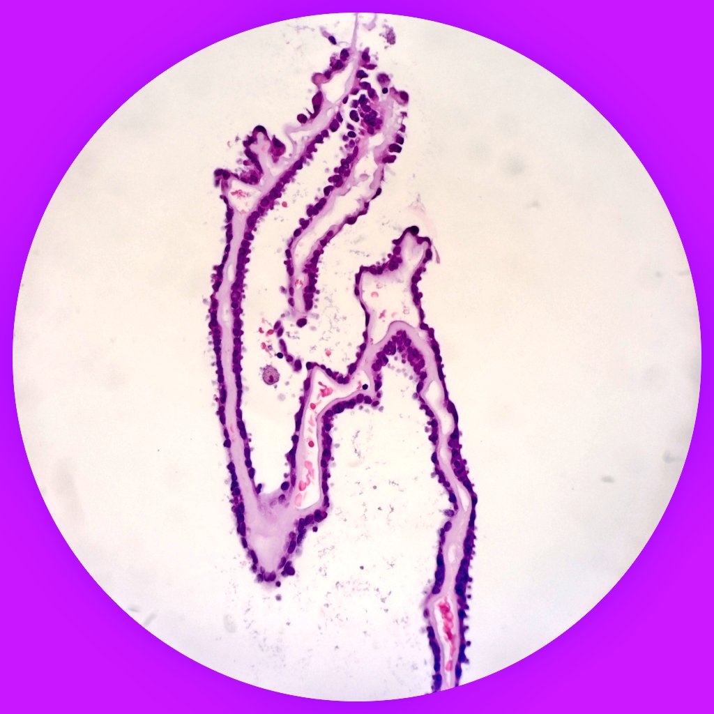 USFNA_SPAIN's tweet photo. 🏥 Medical record: Thyroidectomy. PTC.
💻 Cervical lymph node. 📏 13mm.
💉 Ultrasound guided fine needle aspiration performed by Interventional Pathologist.
1️⃣ Pass.
🔬 Category 5️⃣ Sydney/WHO System. Metastatic Papillary Thyroid Carcinoma.
#Cytology #CyPath #PathX #PathTwitter https://t.co/PuBulMIJST