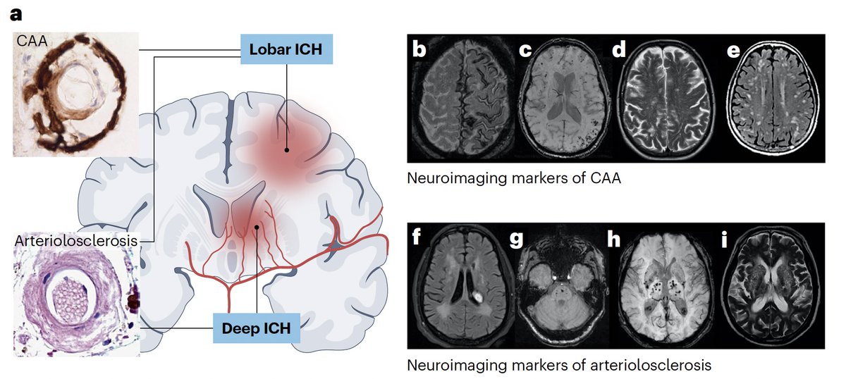 UCL Stroke Research (@uclstrokeres) on Twitter photo By popular demand here's a shareable link - rdcu.be/d0JxK - to our Review on #stroke due to #intracerebralhaemorrhage in <a href="/NatRevNeurol/">Nat Rev Neurology</a> <a href="/DavidSeiffge/">David Seiffge</a> <a href="/SimonFaHo/">Simon Fandler-Höfler</a> <a href="/mbgoeldlin/">Martina Göldlin</a>; this provides access to a full PDF version of the article that can be shared and printed. Enjoy! By popular demand here's a shareable link - rdcu.be/d0JxK - to our Review on #stroke due to #intracerebralhaemorrhage in <a href="/NatRevNeurol/">Nat Rev Neurology</a> <a href="/DavidSeiffge/">David Seiffge</a> <a href="/SimonFaHo/">Simon Fandler-Höfler</a> <a href="/mbgoeldlin/">Martina Göldlin</a>; this provides access to a full PDF version of the article that can be shared and printed. Enjoy!