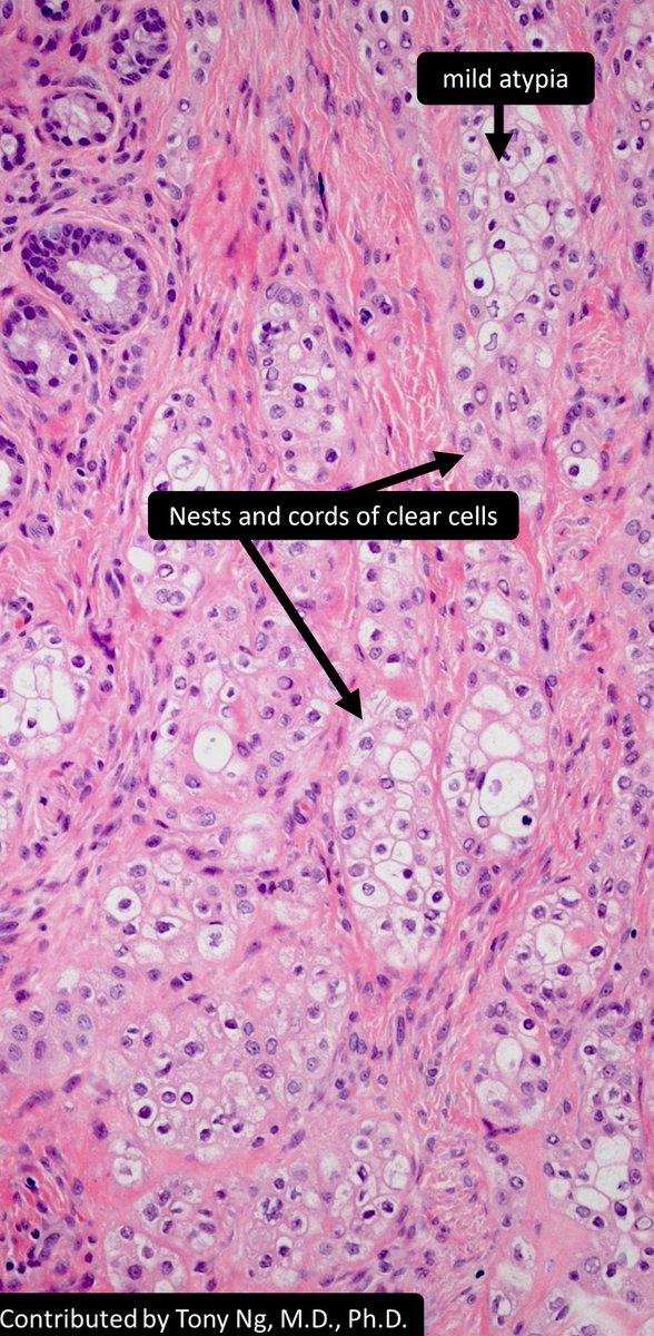 ✅Hyalanizing clear cell carcinoma
Site: intraoral glands, esp tongue's
Micro: sheets &amp; nests of clear/eosinophilic polygonal cells, hyalinized stroma
p63+ p40+ keratin+ S100-
myoepithelial markers negative
EWSR1::ATF1 (also seen in angiomatoid fibrous histiocytoma)