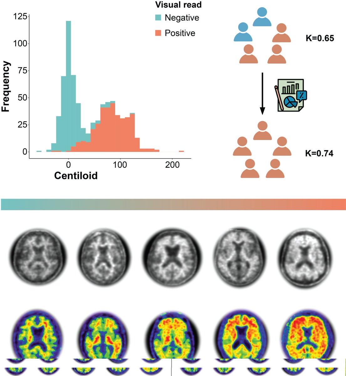 Lyduine Collij (@lecollij) on Twitter photo Does amyloid-PET quantification really support visual assessment❓ Yes❗
In this latest <a href="/IMI_AMYPAD/">AMYPAD</a> paper, we show how the value of quant in challenging clinical cases 🧐
Check out the paper below 👇
<a href="/VGaribotto/">Valentina Garibotto</a> <a href="/SilviaMorbelli/">Silvia Morbelli</a> <a href="/FBarkhof/">Frederik Barkhof</a> Does amyloid-PET quantification really support visual assessment❓ Yes❗
In this latest <a href="/IMI_AMYPAD/">AMYPAD</a> paper, we show how the value of quant in challenging clinical cases 🧐
Check out the paper below 👇
<a href="/VGaribotto/">Valentina Garibotto</a> <a href="/SilviaMorbelli/">Silvia Morbelli</a> <a href="/FBarkhof/">Frederik Barkhof</a>