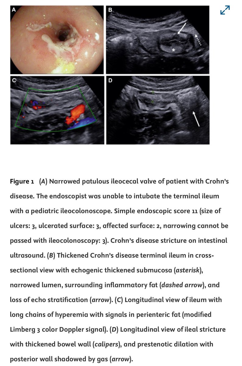 CathyLuMD's tweet photo. Unsure when to ✂️, stretch, or treat inflammation in strictures? Have a 👀 at our Gastro Grand Rounds! https://t.co/yhNcwBv3a4
@IBD_FloMD @HolubarStefan @AGA_Gastro @BowelUltrasound @iUSCAN #star consortium #brianfeagan https://t.co/8vK1m8TgrM