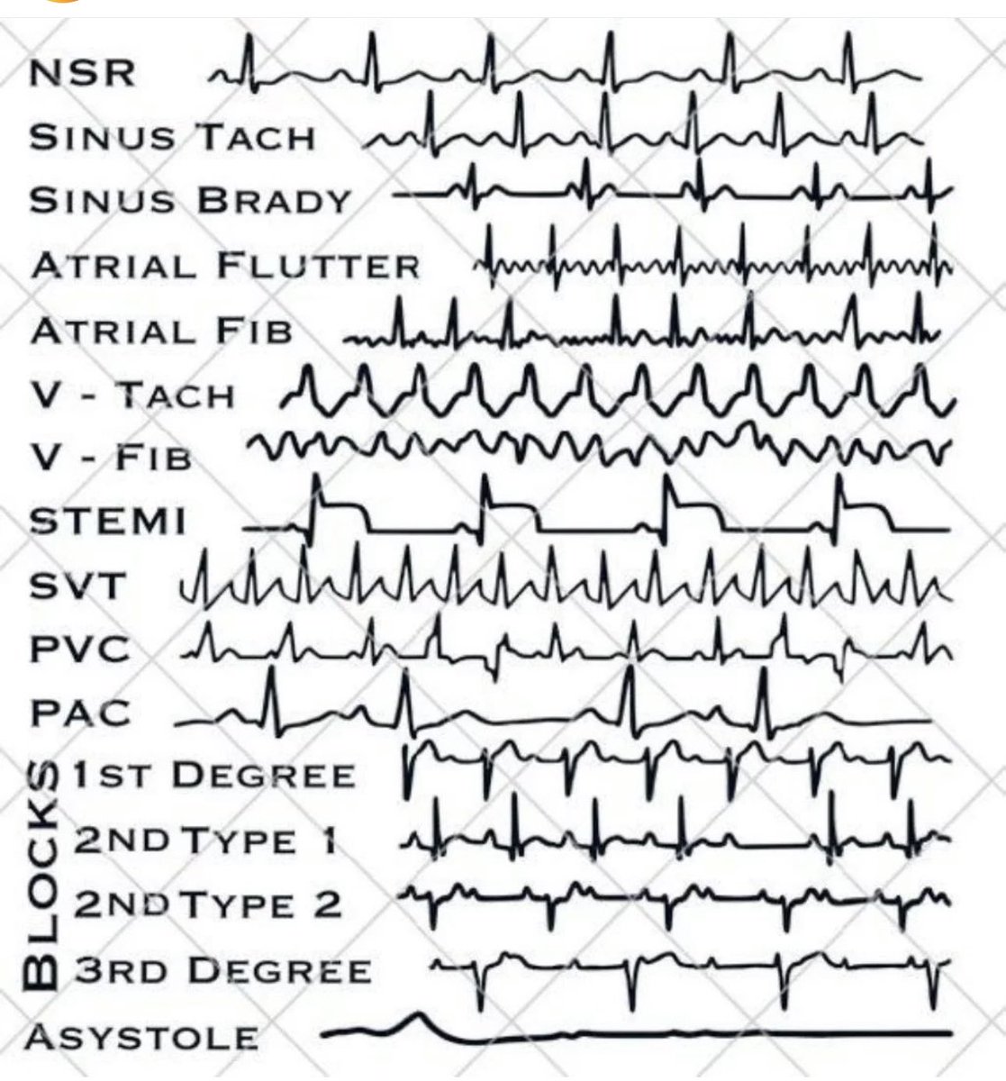 ECG