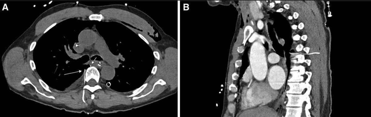 IARS_Journals's tweet image. Can you tell what&apos;s wrong with with this image on #CT?

Unintentional Placement of #Thoracic #Epidural Catheter 

buff.ly/3Oekaoq 

#RegionalAnesthesia #Anesthesia #Radiology