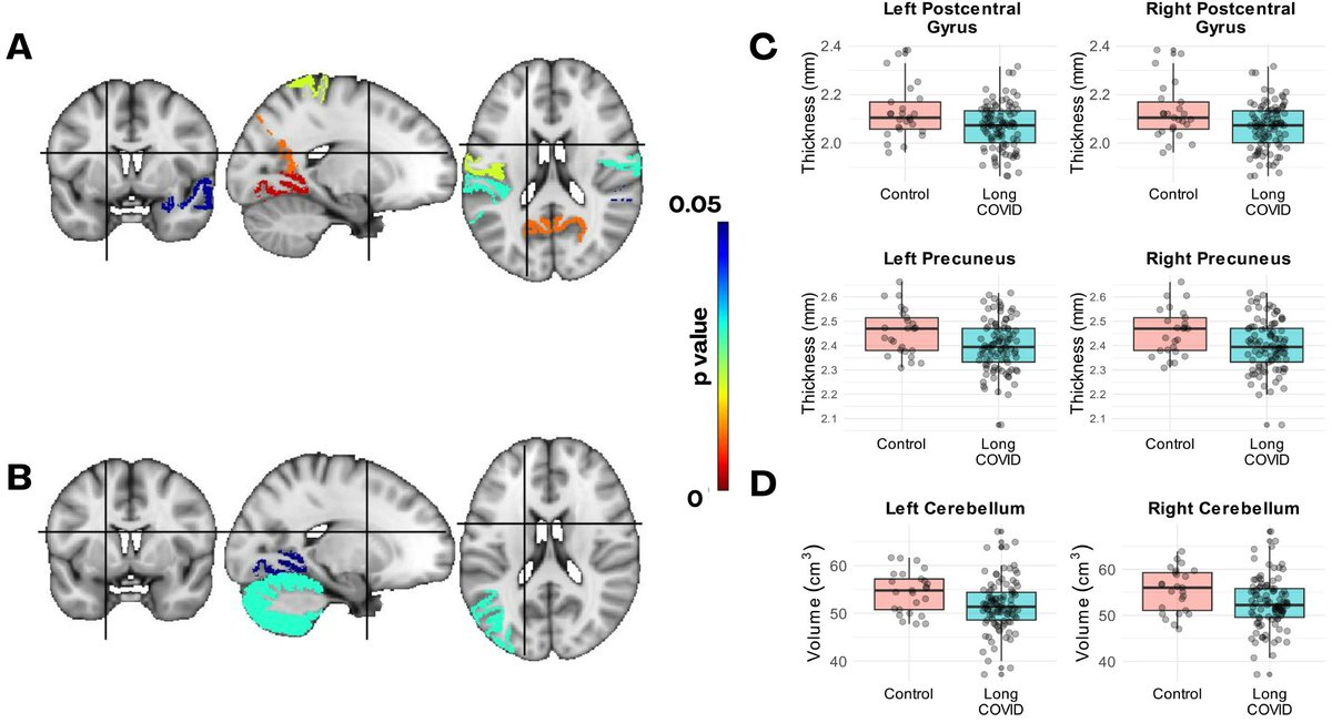 Read my latest #research on the neurological impact of #longcovid, published with <a href="/SpringerNature/">Springer Nature</a> in <a href="/BMC_series/">BMC Series</a> Neurology: rdcu.be/d0GhA