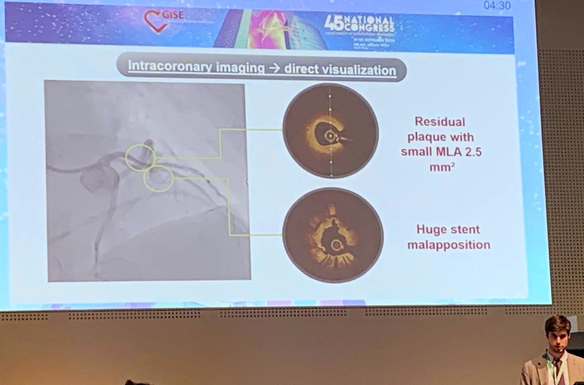 Francesco Bruno (@cescobruno) on Twitter photo 📣 Live now in Room BROWN 2 at #GISE45
The dark side of complete revascularization in MI patients 🔥
💫 Terrific sessions on impact of physiology-guided and imaging-guided on NCLs
Don’t trust only the angiography!
<a href="/DaniTore74/">Daniele Torella</a> <a href="/gianluca980/">Gianluca Caiazzo</a> <a href="/FBiccire/">Flavio Biccirè</a> 📣 Live now in Room BROWN 2 at #GISE45
The dark side of complete revascularization in MI patients 🔥
💫 Terrific sessions on impact of physiology-guided and imaging-guided on NCLs
Don’t trust only the angiography!
<a href="/DaniTore74/">Daniele Torella</a> <a href="/gianluca980/">Gianluca Caiazzo</a> <a href="/FBiccire/">Flavio Biccirè</a>