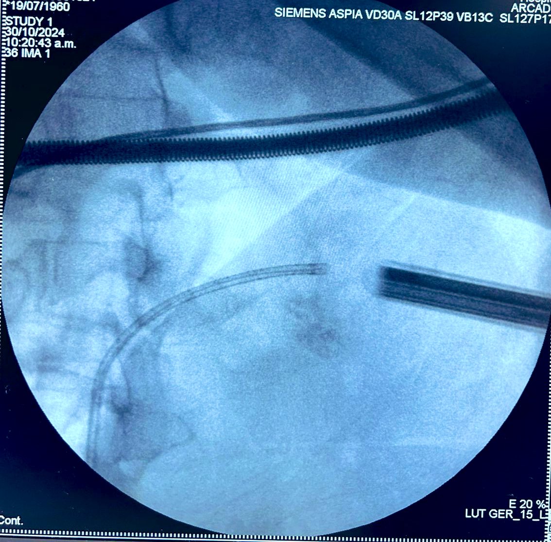Omar Gómez Abraján 🇲🇽 (@ogomezabrajan) on Twitter photo 62 YO Male w/cronic haematuria & flank intermitent pain. We did supine PNL, didn’t solve the total stone burden because of bleeding. 2nd approach, had to get it right! #ECIRS
<a href="/2fabiosepulveda/">Fábio Sepúlveda</a> <a href="/Miguel_pitufo/">J.Miguel Suarez</a> <a href="/EndourologyT/">T&T Endourology</a> <a href="/Endo_Society/">Endourological Society</a> <a href="/sbinhamrii/">Saeed Bin Hamri</a> <a href="/drkemalsarica/">Kemal Sarıca</a> <a href="/niteshkuro/">Nitesh Kumar</a> 62 YO Male w/cronic haematuria & flank intermitent pain. We did supine PNL, didn’t solve the total stone burden because of bleeding. 2nd approach, had to get it right! #ECIRS
<a href="/2fabiosepulveda/">Fábio Sepúlveda</a> <a href="/Miguel_pitufo/">J.Miguel Suarez</a> <a href="/EndourologyT/">T&T Endourology</a> <a href="/Endo_Society/">Endourological Society</a> <a href="/sbinhamrii/">Saeed Bin Hamri</a> <a href="/drkemalsarica/">Kemal Sarıca</a> <a href="/niteshkuro/">Nitesh Kumar</a>