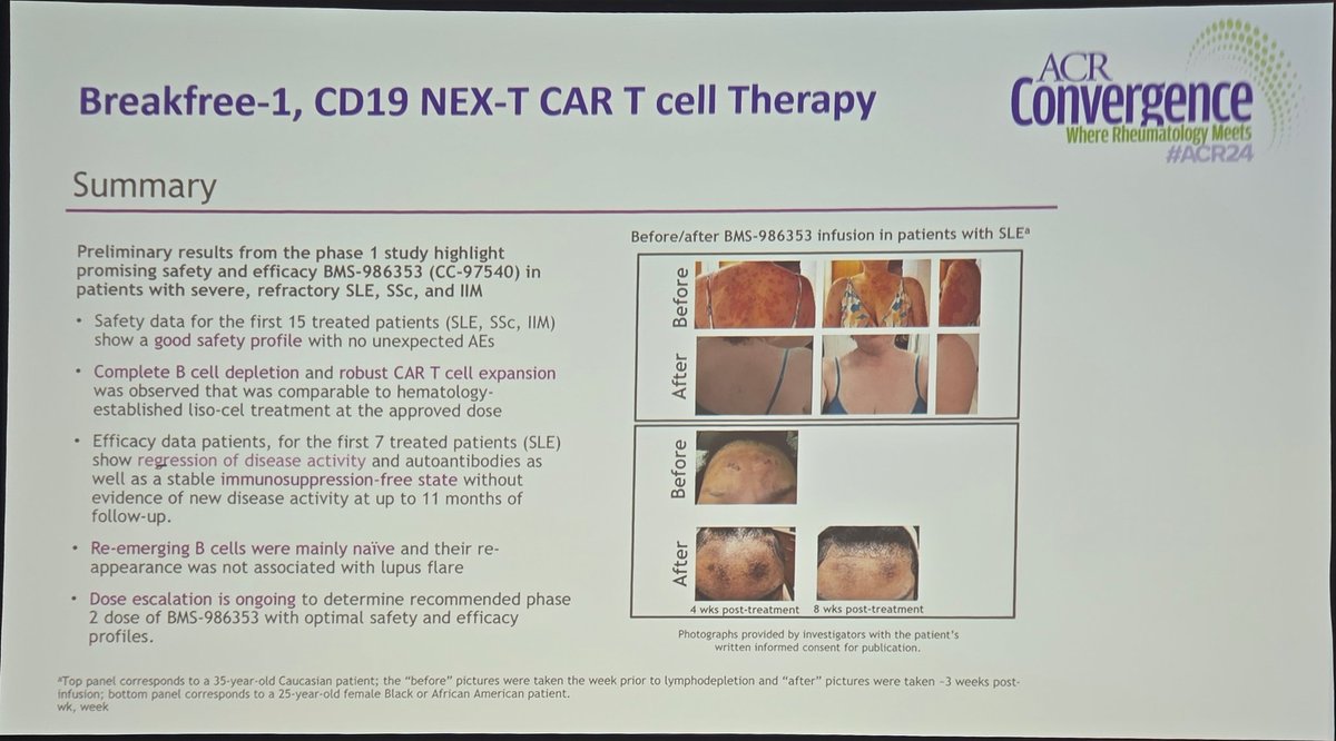 Annals of the Rheumatic Diseases (@eular_ard) on Twitter photo #ACR24: The year of cell therapy in autoimmune diseases and redefining Tx paradigms!
🧬 Breakfree-1 CD19 CAR-T therapy shows sustained clinical remission in refractory #SLE and a safer profile.
🔬 Next-gen technology on the way. Stay tuned for more!
<a href="/Dr_AndreRibeiro/">André Ribeiro</a> #ACR24: The year of cell therapy in autoimmune diseases and redefining Tx paradigms!
🧬 Breakfree-1 CD19 CAR-T therapy shows sustained clinical remission in refractory #SLE and a safer profile.
🔬 Next-gen technology on the way. Stay tuned for more!
<a href="/Dr_AndreRibeiro/">André Ribeiro</a>