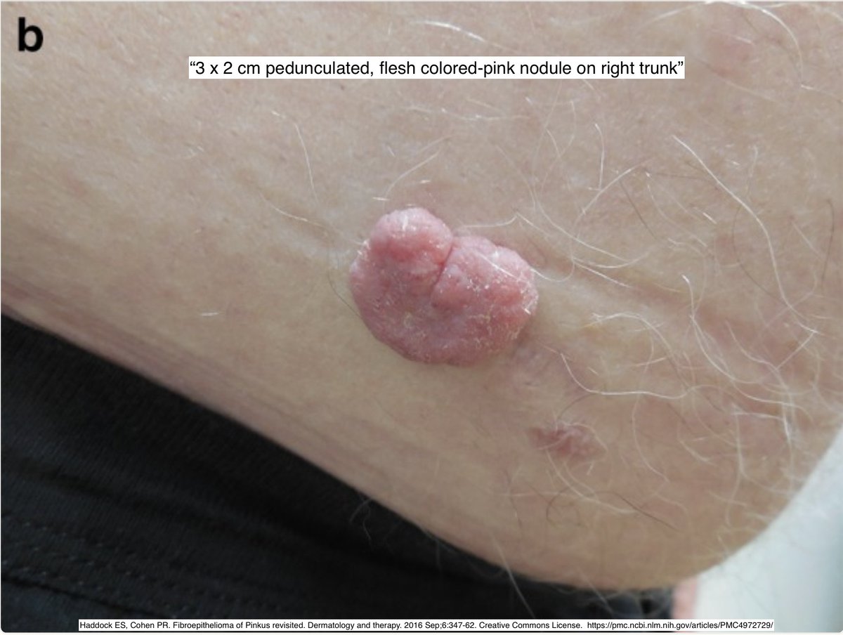 Path4People's tweet photo. I am considered either a type of Basal Cell Carcinoma v. Trichoblastoma
I have strands of keratinocytes with basaloid nests, forming a net like/reticular architecture
I am named after a dermatologist/dermatopathologist🔬
Who am I?🤔
#pathx #path4people #dermpath #pathagonia https://t.co/wgtSGWCh14
