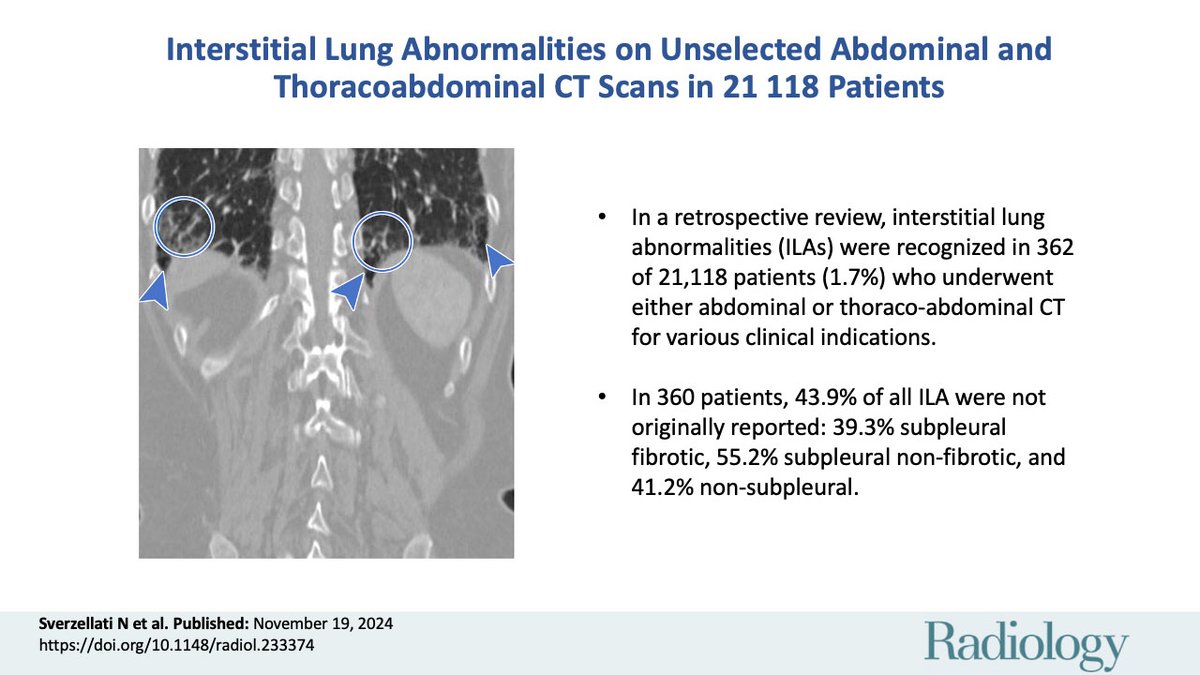 Over 40% of interstitial lung abnormalities went unreported in a sample of 20,000+ patients who underwent abdominal or thoracoabdominal CT for various clinical reasons.
pubs.rsna.org/doi/10.1148/ra…
