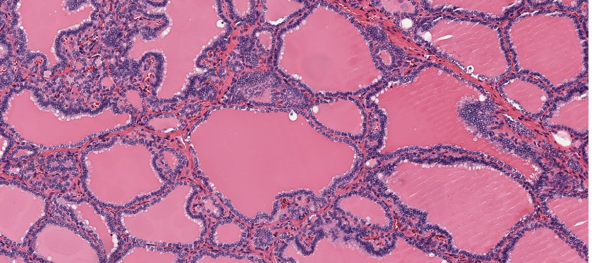 Join us at 2025 London Endocrine Pathology Update on 10th-11th February wix.to/KwbOSig
#rsvpnow #savethedate