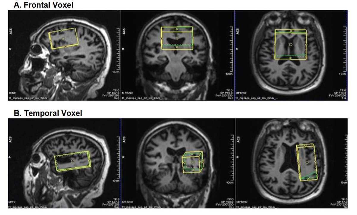 GeroScience (@geroscienceage) on Twitter photo 📢New in GeroScience by Springer Nature
Neurocognitive correlates of cerebral mitochondrial function and energy metabolism using phosphorus magnetic resonance spectroscopy in older adults by Francesca V. Lopez & Adam J. Woods (<a href="/adamjwoods/">Adam J. Woods, Ph.D.</a>) , Dawn Bowers (<a href="/magmophd/">Dawn Bowers</a>) et al. 📢New in GeroScience by Springer Nature
Neurocognitive correlates of cerebral mitochondrial function and energy metabolism using phosphorus magnetic resonance spectroscopy in older adults by Francesca V. Lopez & Adam J. Woods (<a href="/adamjwoods/">Adam J. Woods, Ph.D.</a>) , Dawn Bowers (<a href="/magmophd/">Dawn Bowers</a>) et al.