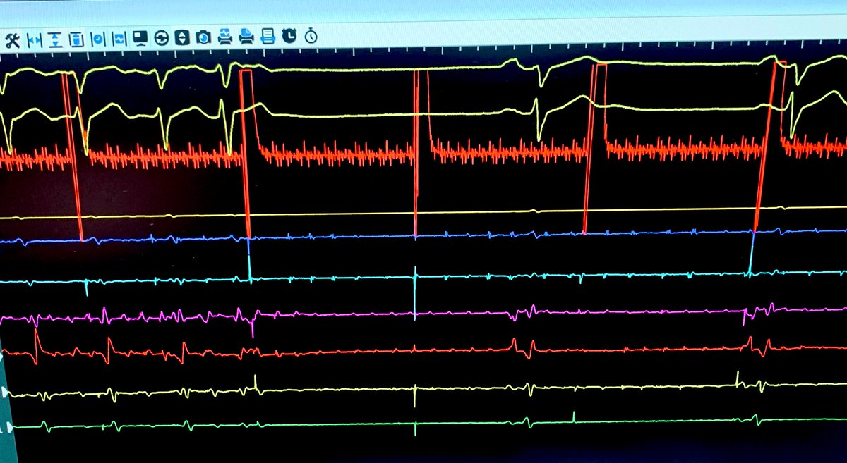 Olga Durán Bobin (@odbobin) on Twitter photo Today in the EP lab: conversion of AF to SR on achievement of PV-LA exit block from the LIPV during cryoablation ❄️❄️❄️in a patient with persistent AF. It could be considered a favorable sign with respect to AF recurrence rate. We will see 👀🤓 #AF #cryo <a href="/UICARarritmias/">UICAR Unidad de Arritmias</a> Today in the EP lab: conversion of AF to SR on achievement of PV-LA exit block from the LIPV during cryoablation ❄️❄️❄️in a patient with persistent AF. It could be considered a favorable sign with respect to AF recurrence rate. We will see 👀🤓 #AF #cryo <a href="/UICARarritmias/">UICAR Unidad de Arritmias</a>