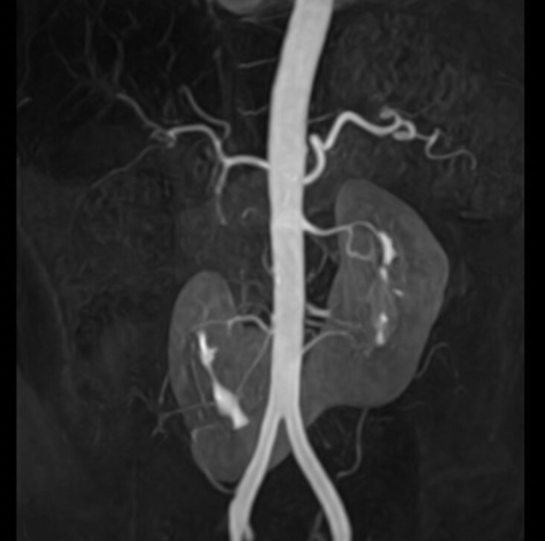 🧲Riñón en Herradura
Fusión de polos renales inferior izquierdo y derecho
🔍La ascencion renal se interrumpe cuando el riñón fusionado se atrapa en AMI
🧬Más incidencia Trisomía 13, 18, 21 y Turner
👦🏻Asintomático, Dx incidental.
🩺Riesgo de cálculos renales y obstrucción
