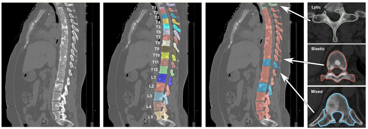 🚨 New dataset 🚨 "Spine-Mets-CT-SEG" (doi.org/10.7937/kh36-d…) contains pre and post radiotherapy CT images with vertebrae segmentation, lesion classification, and demographic data from 55 patients diagnosed with various primary cancers and metastatic spine disease.