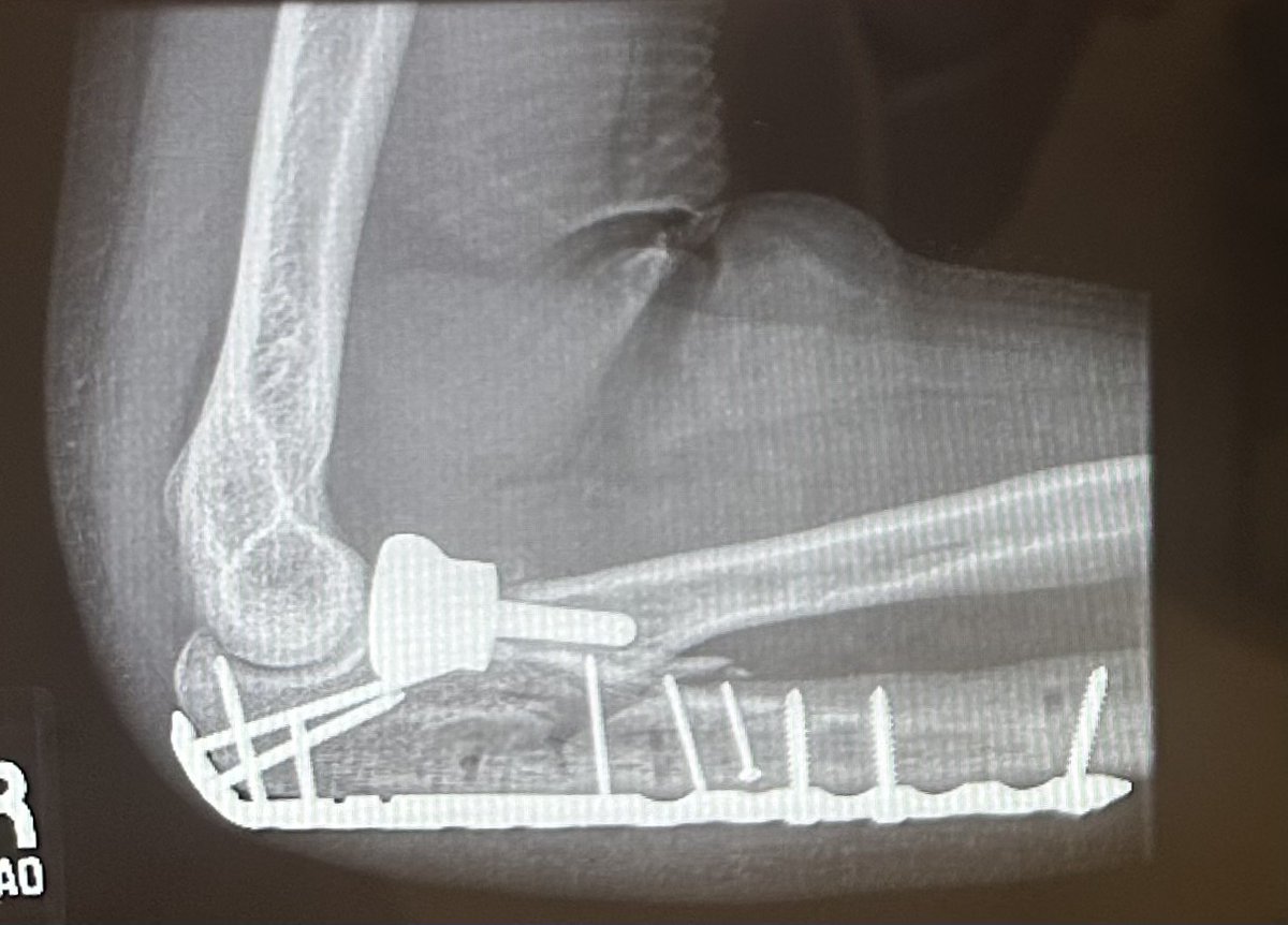 jaap_null's tweet image. Shout-out to dr Lucas and the SCVMC ortho surgery dept. 🦾🏥Doctors keep telling me it exceptional to recover this well from a catastrophic fracture like this. Closing the chapter on PT soon and moving on to strength training. Limited supination should improve still.