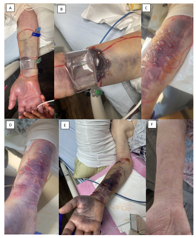 InvasiveCardiol's tweet image. 🆕 in Early View: Hemorrhagic Epidermal Bullae Following Transradial Percutaneous Coronary Intervention okt.to/RNL0Ax
@AmartyaKundu_MD @DLBHATTMD #cardioTwitter #cardioX #cardiology #interventionalcardiology