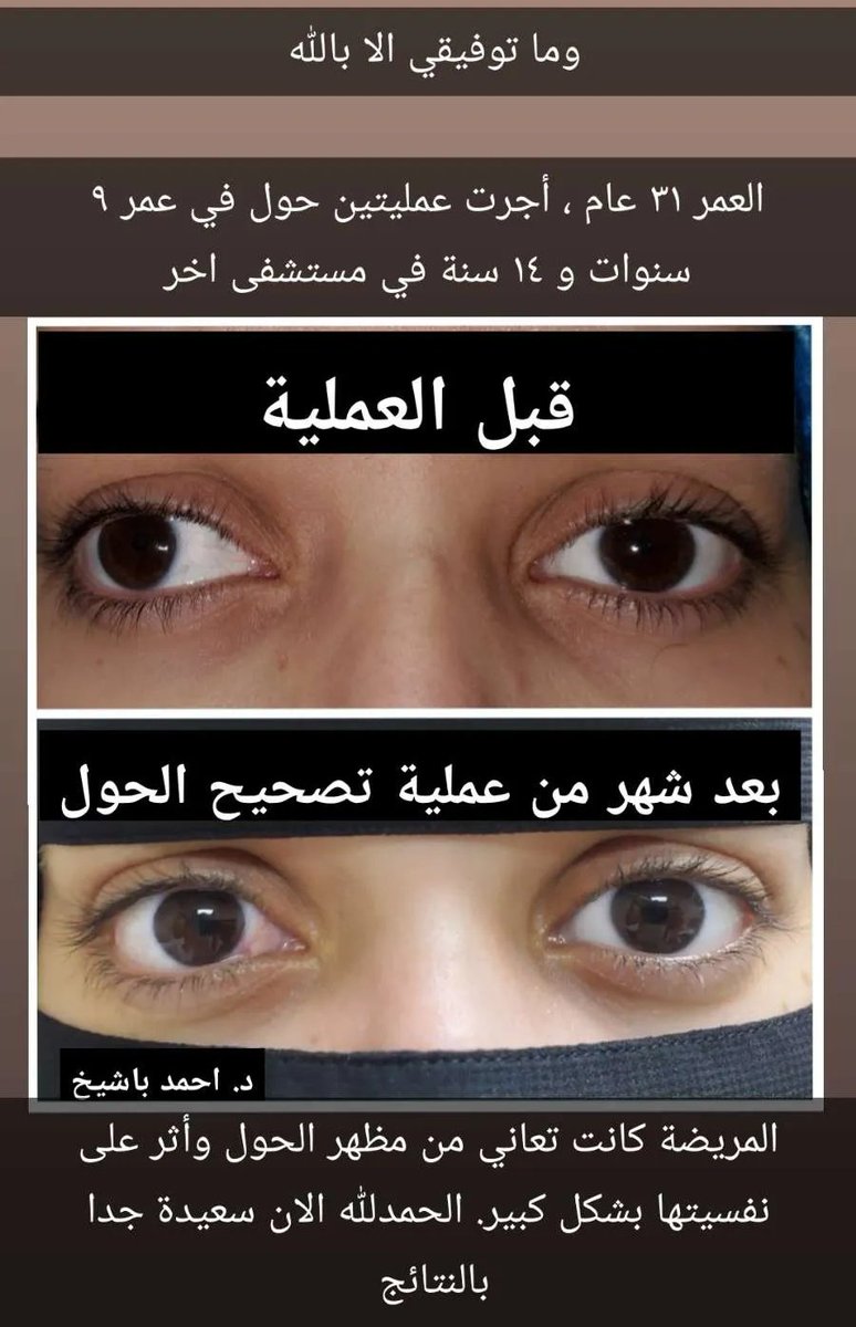 مظهر الحول يؤثر بعض الأحيان على نفسية المريض بشكل سلبي ويقلل من ثقته بنفسه. تعديل الحول ليس تجميلي (تكميلي) ، بل هو لإعادة العين لمظهرها الطبيعي.
في الصورة مريضة أجريت لها مؤخرا عملية حول معقدة ، والحمدلله النتائج رائعة. وما توفيقي الا بالله.