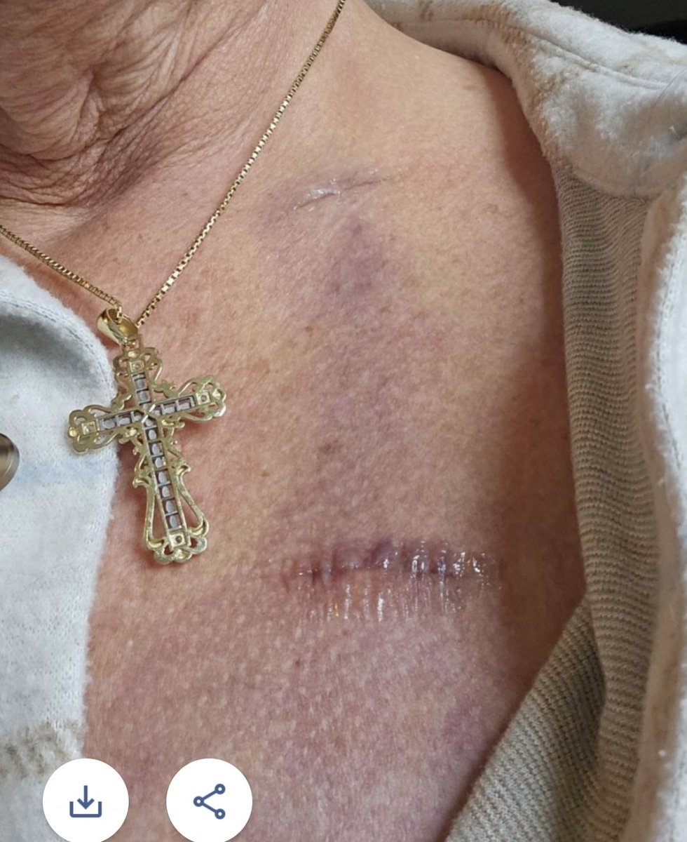 ABwithus's tweet image. Congratulations. God bless. I can't wait for that day. It seems so close but so far away. 6 weeks ago, I was diagnosed with stage 3 ovarian cancer. Finished my second chemo a week ago.