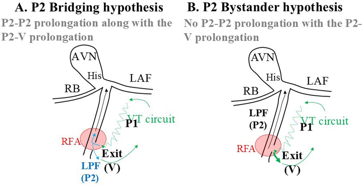 Heart Rhythm Case Reports (@hrs_casereports) on Twitter photo Idiopathic Verapamil-Sensitive Fascicular Ventricular Tachycardia with a Potential Direct Connection of the Antegrade Limb to the Retrograde Myocardial Limb, without Bridging of the Left Posterior Fascicle
<a href="/AtsuhikoYagish1/">Atsuhiko Yagishita</a>
heartrhythmcasereports.com/article/S2214-… Idiopathic Verapamil-Sensitive Fascicular Ventricular Tachycardia with a Potential Direct Connection of the Antegrade Limb to the Retrograde Myocardial Limb, without Bridging of the Left Posterior Fascicle
<a href="/AtsuhikoYagish1/">Atsuhiko Yagishita</a>
heartrhythmcasereports.com/article/S2214-…