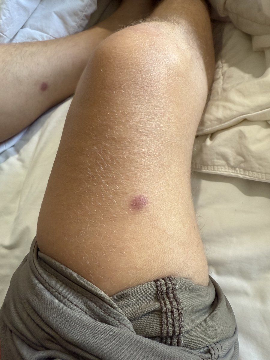 Digiwhale_CTO's tweet image. The only symptom i had before i was diagnosed with AML leukemia. My WBC was over 100k at this point and i was weeks away from organ failure and i had no idea. A handful of what i thought were bug bites. Absolutely crazy to me.