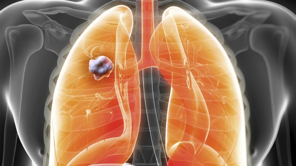 L’ARN messager pour combattre le #cancerdupoumon. Des patients du Centre universitaire de santé #McGill parmi les premiers au monde à tester son efficacité.
ici.radio-canada.ca/nouvelle/21225…
#recherche