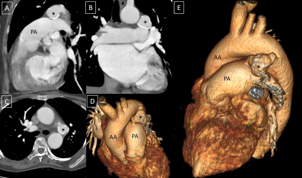 Journal of Invasive Cardiology (@invasivecardiol) on Twitter photo 📕 The December issue is out now! Read here:
okt.to/NIrofL
<a href="/DLBHATTMD/">Dr. Deepak L. Bhatt</a> <a href="/AhmedAlOgaili/">Ahmed Al-Ogaili</a> <a href="/esbrilakis/">Emmanouil Brilakis</a> <a href="/DrArgyle/">R. Jay Widmer</a> <a href="/DrArgyle/">R. Jay Widmer</a> <a href="/Octavio_JiMelo/">Octavio_Jimenez-Melo</a> <a href="/SripalBangalore/">Sripal Bangalore</a> #cardioTwitter #cardioX #cardiology #interventionalcardiology 📕 The December issue is out now! Read here:
okt.to/NIrofL
<a href="/DLBHATTMD/">Dr. Deepak L. Bhatt</a> <a href="/AhmedAlOgaili/">Ahmed Al-Ogaili</a> <a href="/esbrilakis/">Emmanouil Brilakis</a> <a href="/DrArgyle/">R. Jay Widmer</a> <a href="/DrArgyle/">R. Jay Widmer</a> <a href="/Octavio_JiMelo/">Octavio_Jimenez-Melo</a> <a href="/SripalBangalore/">Sripal Bangalore</a> #cardioTwitter #cardioX #cardiology #interventionalcardiology