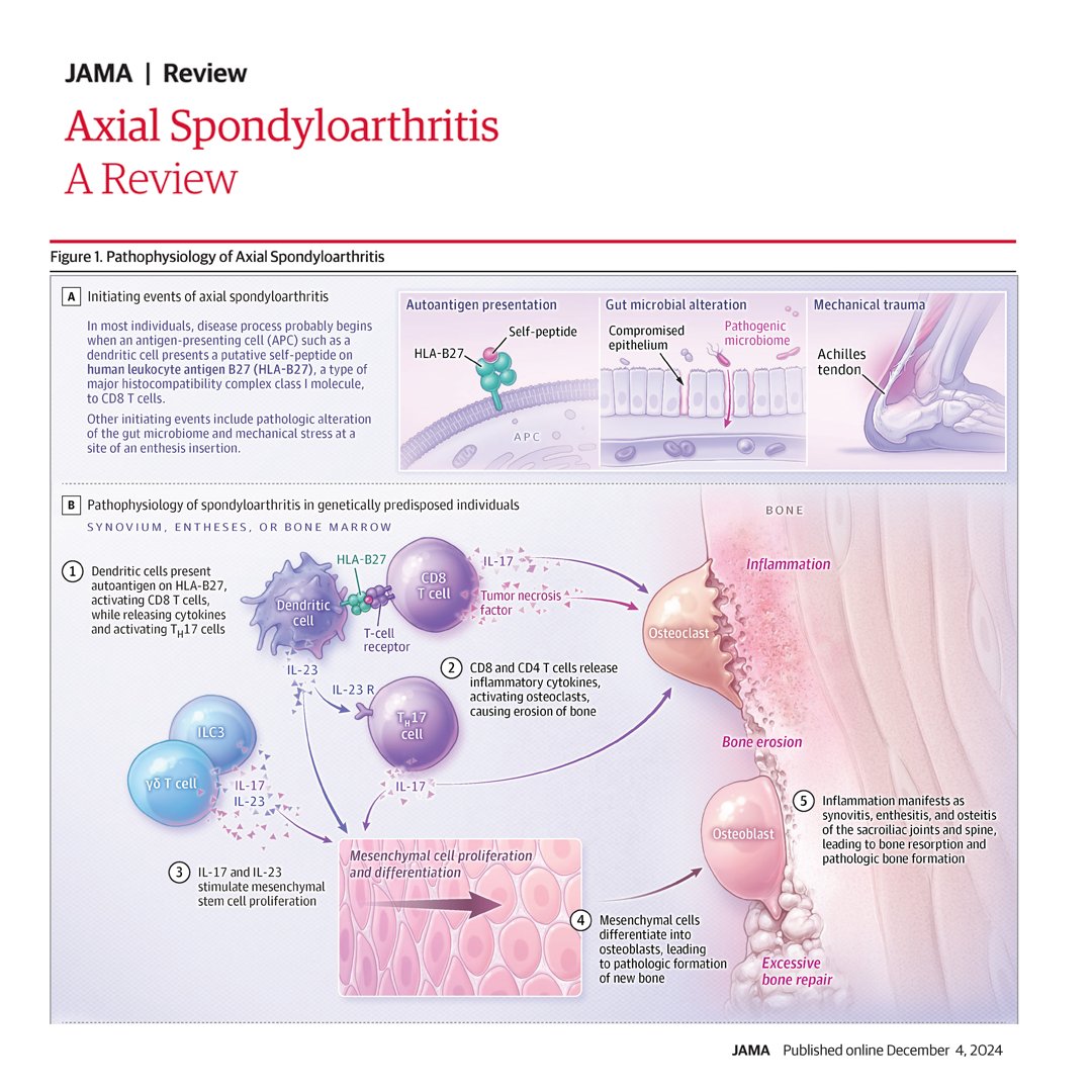 Axial spondyloarthritis is an inflammatory condition involving the sacroiliac joints, spine, and peripheral joints. This narrative review discusses the pathogenesis, epidemiology, diagnosis, and treatment of axial spondyloarthritis.

ja.ma/49lzbOZ