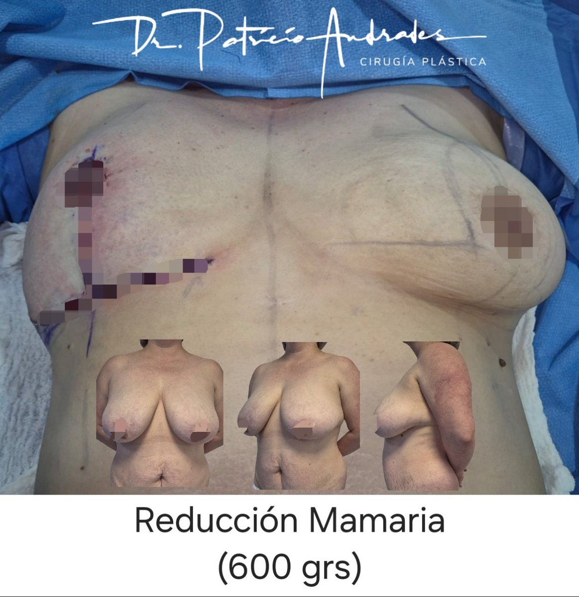 La #ReducciónMamaria siempre deja cicatrices. Estas cicatrices son la mayoría de las veces peri-areolar, vertical y horizontal (ancla). Con una longitud que va entre los 40-45 cms de cicatriz, es muy importante extremar los cuidados postoperatorios para evitar complicaciones.