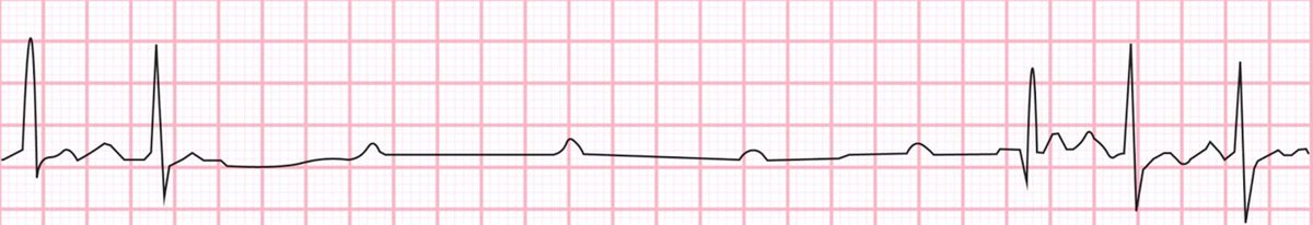(1/x) For patients in shock we are good at optimizing preload, vasopressors, and inotropy 💉🏥

However...

We often overlook one important hemodynamic variable... Heart Rate 🫀

Here's when we should address inappropriately low (or high) HRs for patients in shock

(and one