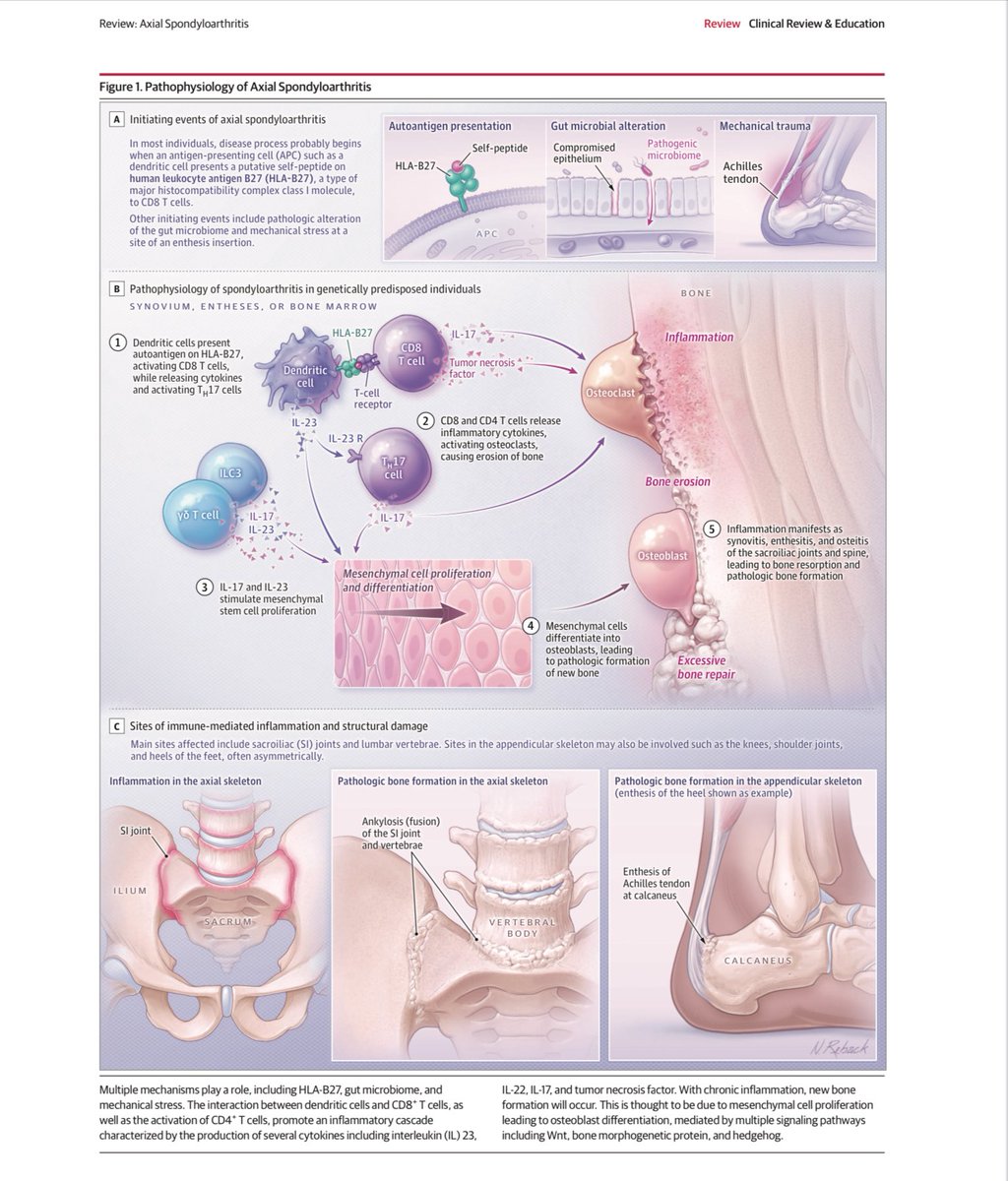 Retlouping's tweet image. Axial Spondyloarthritis
A Review

jamanetwork.com/journals/jama/…