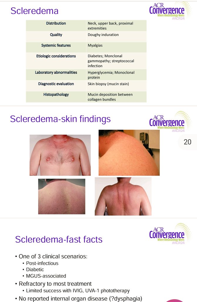 👉Scleroderma mimicker 
💥Scleredema 
👉Proximal extremity, neck ,upper 🔙 
🌟Doughy induration 
✅Post infection, diabetes
✅No systemic symptom #ACR2024 #ACRAmbassador