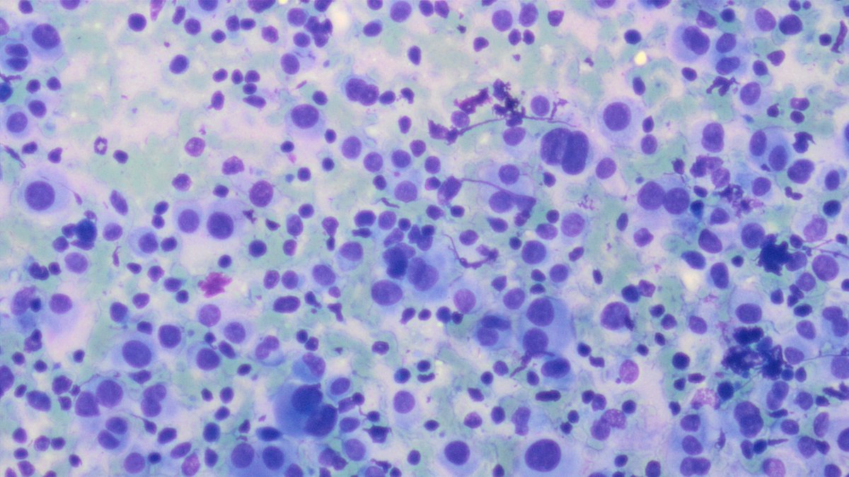 UABPathology's tweet photo. #UABCyto case by Dr. Igor Damasceno: 67 y/o F w/ cervical adenopathy. DQ smears are highly cellular w/ small lymphocytes and epithelioid dyshesive cells, w/ enlarged nuclei, bi and multinucleation, some w/ nucleoli and nuclear pseudoinclusions. SOX10 positive. Metastatic melanoma https://t.co/IWyc7Ysnc4