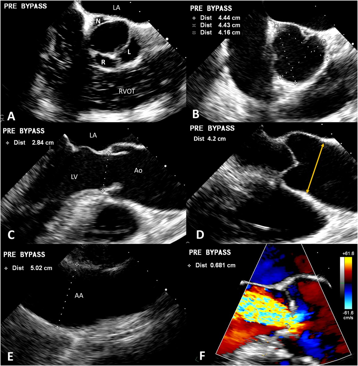 We've released a State-of-the-Art Review, "Noninvasive Imaging for Native Aortic Valve Regurgitation!"

Read our <a href="/JournalASEcho/">JASE</a> article: bit.ly/4gmVtCt
