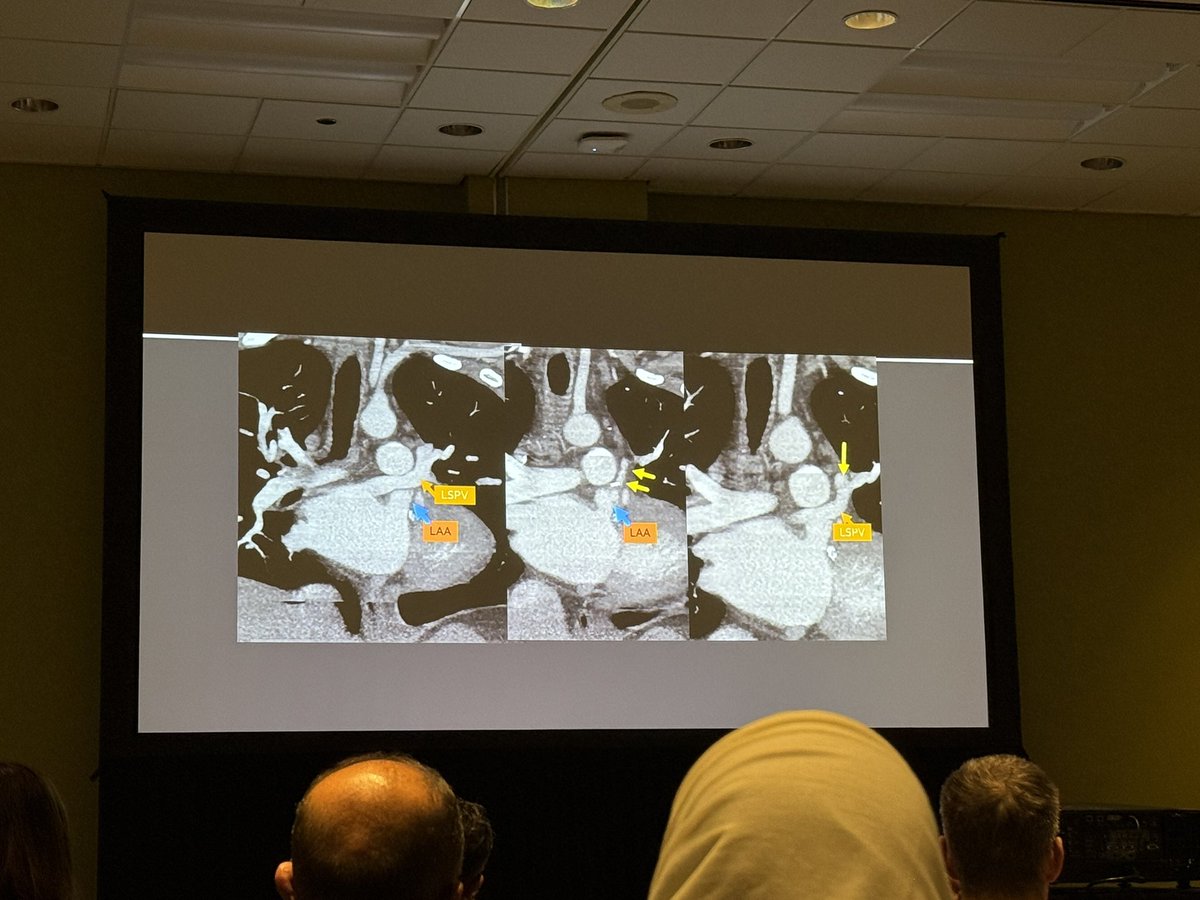 Thurl Cledera (@thurlcledera) on Twitter photo Masterclass in 🚼Congenital Vascular Disease by <a href="/prachipagarwal/">Prachi Agarwal</a>
✅Utilize 3D models and don’t neglect the airways in complex CHD
✅Coronary artery supply follows ventricle in TGA
✅Accurate communication with clinicians and proper use of nomenclature is 🔑
#RSNA24 #cvrad Masterclass in 🚼Congenital Vascular Disease by <a href="/prachipagarwal/">Prachi Agarwal</a>
✅Utilize 3D models and don’t neglect the airways in complex CHD
✅Coronary artery supply follows ventricle in TGA
✅Accurate communication with clinicians and proper use of nomenclature is 🔑
#RSNA24 #cvrad