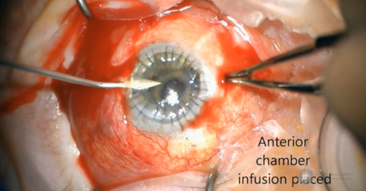 aao_ophth's tweet image. What are the important elements of pre-op management of suprachoroidal hemorrhage? Focus on what matters with the #BCSC. Over 42 surgical videos in Section 11: #Lens and #Cataract. To watch the video, click on the first sample link on this page. ow.ly/cY2M50UfsfL