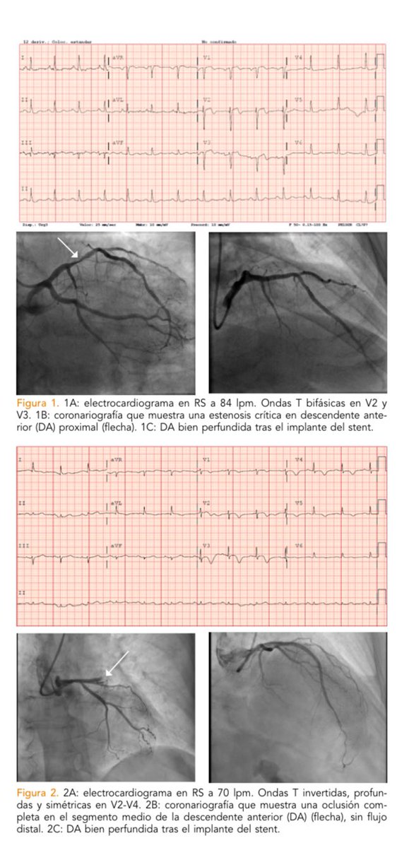 ¿Sabes lo que es el Síndrome de Wellens y cómo identificarlo? No te pierdas este artículo publicado en nuestra <a href="/ReuErevista/">REUErevista</a> <a href="/SEMES_/">SEMES</a> 

reue.org/wp-content/upl…