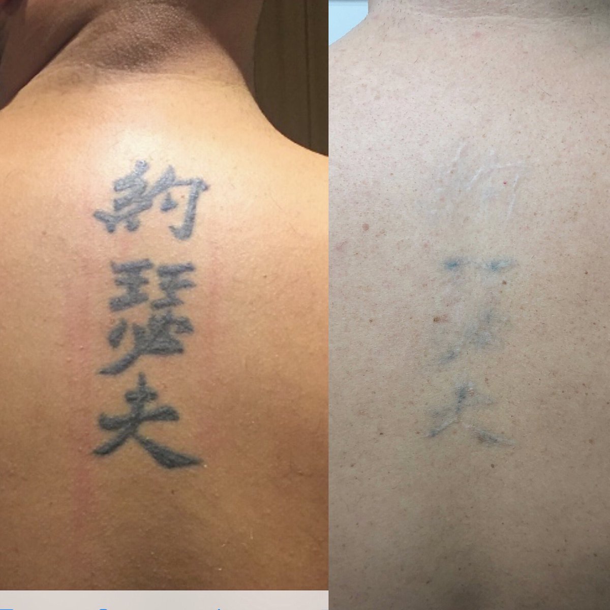 original_laser's tweet photo. After 8 laser treatments. Original tattooing marked the skin slightly https://t.co/hNCbYtQRSL