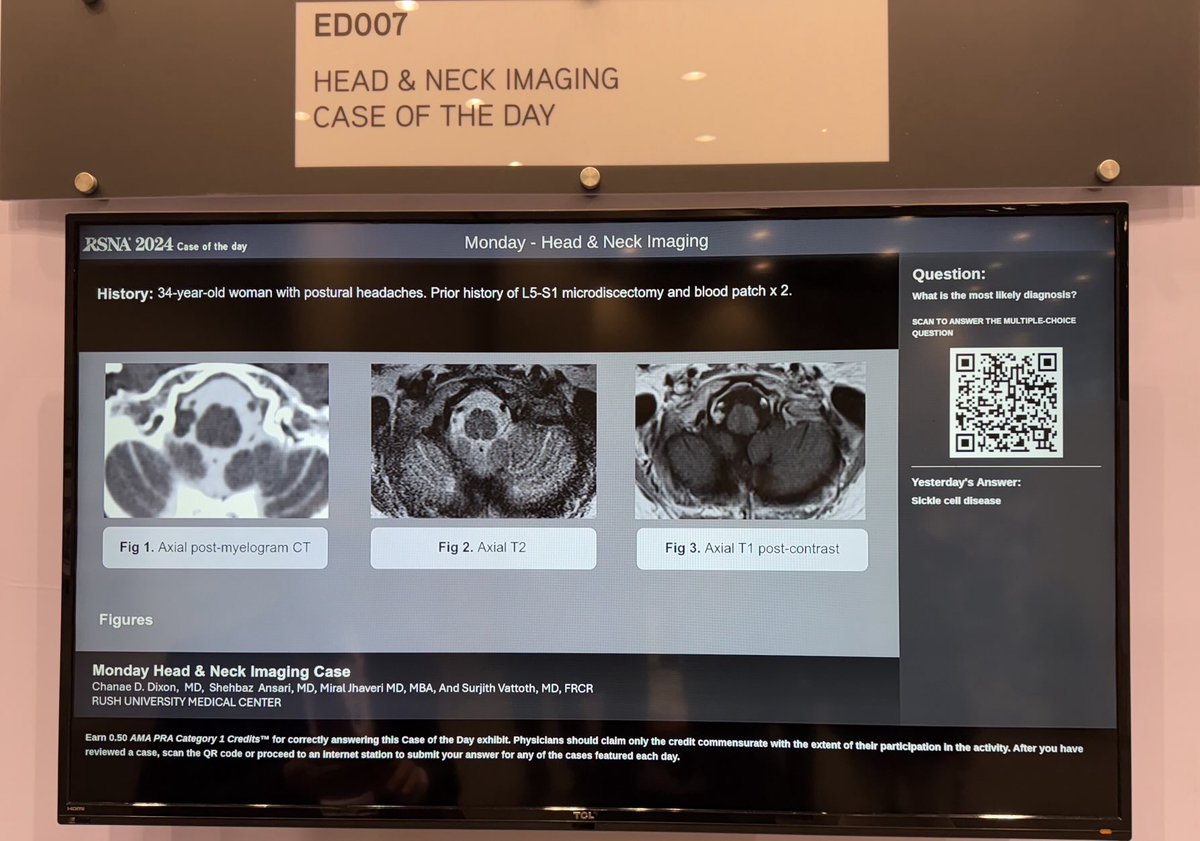 Shehbaz Ansari MD (@shehbazansarimd) on Twitter photo Turn on your smarts! Scan the QR code to answer. Case of the Day at #RSNA2024. <a href="/drSurjthVattoth/">Surjith Vattoth</a> <a href="/RSNA/">RSNA</a> <a href="/CMenias/">Cooky Menias</a> #RGTEAM Turn on your smarts! Scan the QR code to answer. Case of the Day at #RSNA2024. <a href="/drSurjthVattoth/">Surjith Vattoth</a> <a href="/RSNA/">RSNA</a> <a href="/CMenias/">Cooky Menias</a> #RGTEAM