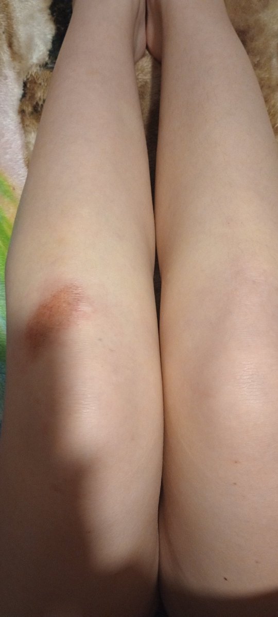 powd3rcals's tweet photo. MY KNEE BRO ALL I DID WAS FALL ON CARPET SPARE ME (ignore how fat my legs are) https://t.co/J3cIxNAcQ6