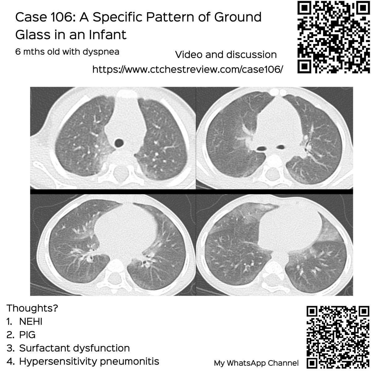 bhavinj's tweet photo. Case 106: A Specific Pattern of Ground Glass in an Infant
6 mths old.
Thoughts?
1. NEHI
2. PIG
3. Surfactant dysfunction
4. HP
Video discussion
https://t.co/J7yiCyFWLy
#ctchest #radres #foamrad #infant #chILD #groundglass https://t.co/C3C1jBiJEJ