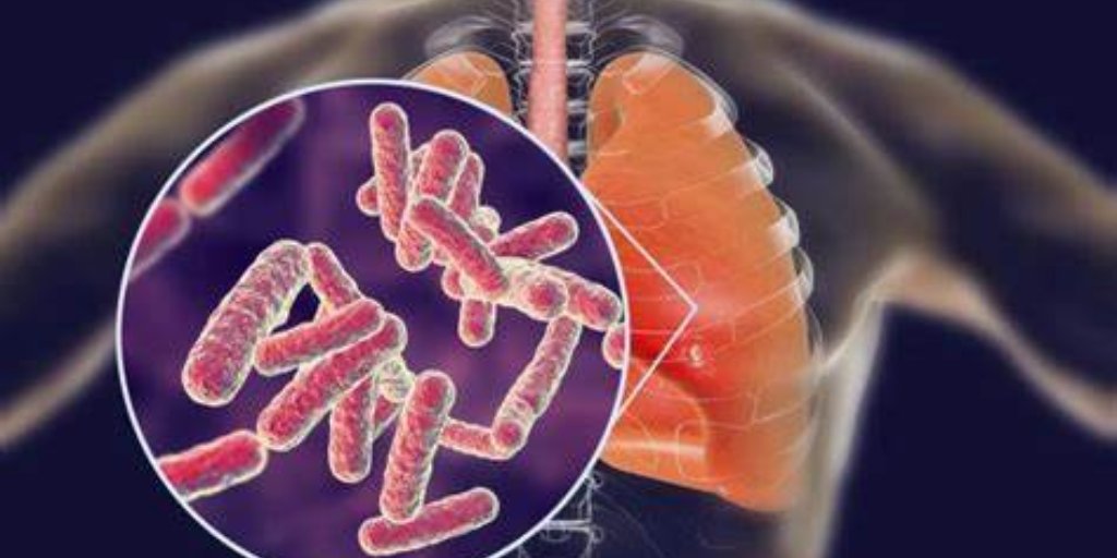 HainanJournal's tweet photo. Moxifloxacin helps treat active tuberculosis more effectively than levofloxacin, boosting recovery and immune system activity!
#tuberculosis #immune #medical
@HainanJournal 
https://t.co/P3DFkRtWAd https://t.co/z0lGYKIB0Q