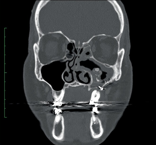 ent_ams's tweet photo. Uncommon clinical challenge: 58-year-old develops #ODS &amp; fungus ball 23 years post-orthognathic surgery. 
🚨 Retained hardware matters!

Discover the case details &amp; surgical management here: https://t.co/QIligBQjvk.

Thanks to @TizianoTestori and @JohnCraigNose https://t.co/gZGQblNzgX