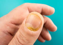 Onychomadesis 🩺📋

Onychomadesis refers to the painless separation of the nail plate from the nail matrix, leading to nail shedding. It commonly affects fingernails and toenails.

Causes:
🔹 Trauma or repetitive injury
🔹 Viral infections (e.g., coxsackievirus in hand-foot-mouth