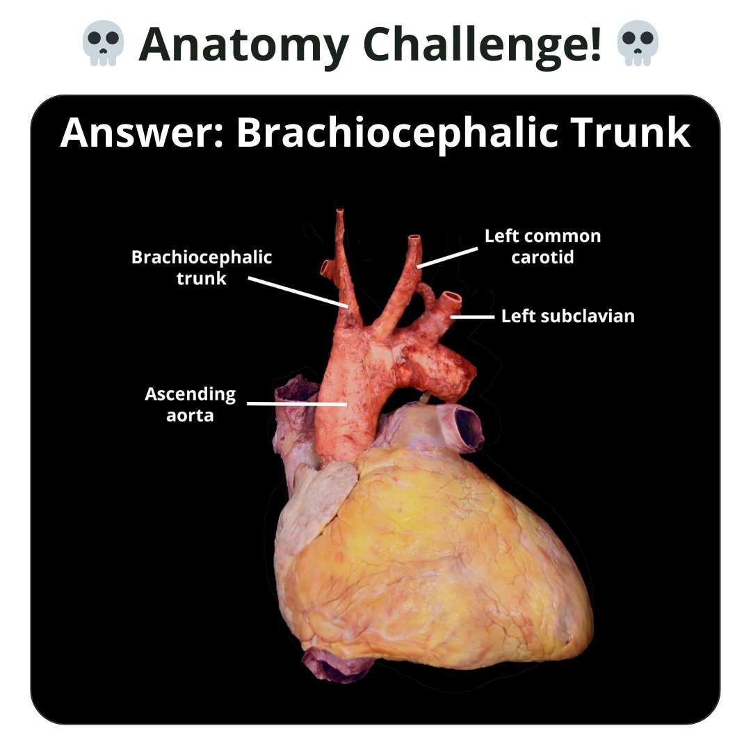 TeachMe_Support's tweet image. Anatomy challenge of the week 🏆 Can you name the structure?  #quizyourself #meded #medschool #medicalstudent #premed #premedlife #nursing #nursingschool #pastudent #physician #futuredoctor #studymotivation #medlife #medschoolmemes #medicalmeme  #medstudentlife  #geekymedics