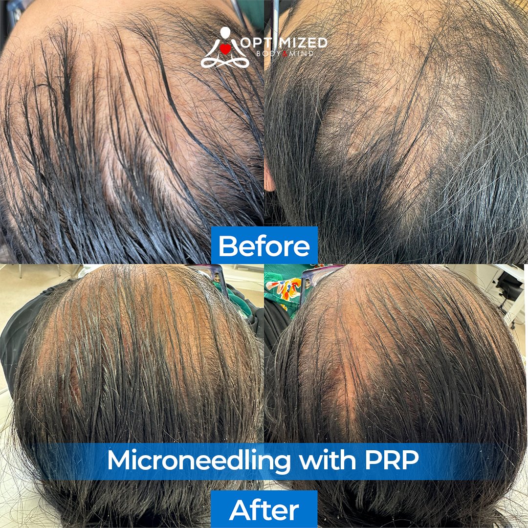 OptimizedBandM's tweet photo. ✨ Get Your Confidence Back with PRP Hair Treatment! ✨

Check out our before-and-after photos to see how PRP treatment restores hair thickness and confidence!

📅 Book Now:
https://t.co/YyLaf8o3bP

#optimizedbodyandmind #hairtreatment #hairtransformation #prp #Luton https://t.co/xGKKADge7w