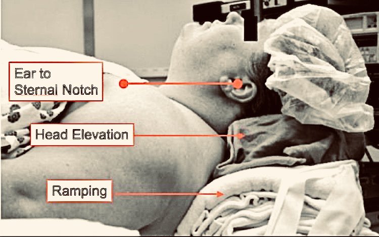 jackcfchong's tweet photo. Airway Management Tips 
https://t.co/7gy3cnT8nm https://t.co/87nasHueD8
