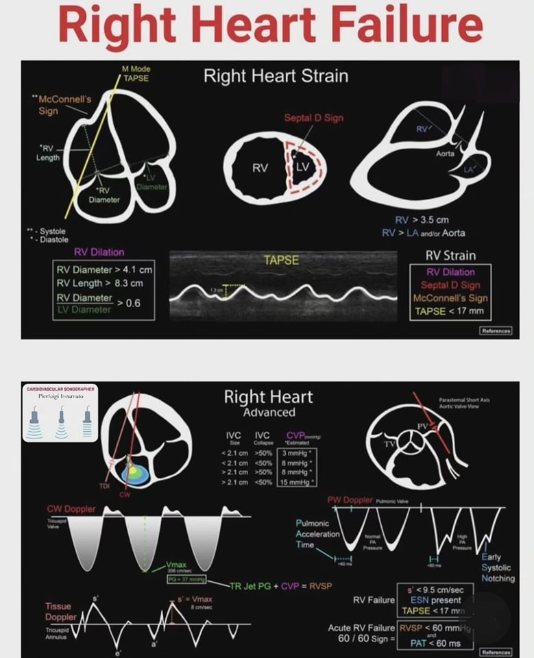 🔴Cardiac Ultrasound Pocket Cards⤵️ ✅Right Heart Failure
    
     Available to download  FREE 
🔹pocus101.com/pocket-cards/
 #FOAMed #MedEd #medstudent #paramedic #Cardiology #CardioEd #medtwitter #meded #CardioTwitter #cardiotwiteros  #MedX #cardiovascular #MedTwitter
